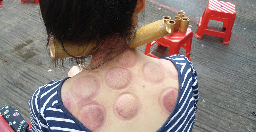 Fire_cupping_Anna-Frodesiak-via-WC