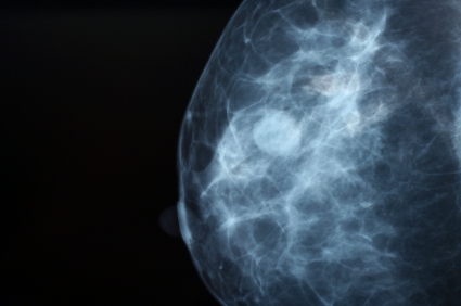 Breast cancer diagnosis